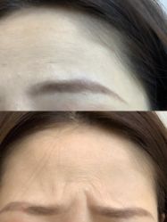 体验前-More摩尔医美の注射线雕光电中心