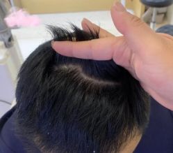 -大麦微针植发丨全国连锁