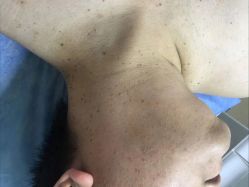 -爱莎扁平疣·汗管瘤·斑痣中心