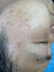 -爱莎扁平疣·汗管瘤·斑痣中心