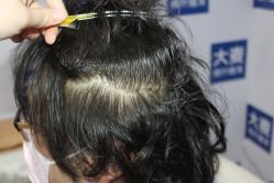 -大麦微针植发丨全国连锁