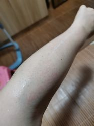 体验后-深圳春天阳光医院·轮廓抗衰中心