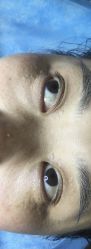 体验前-爱莎扁平疣·汗管瘤·斑痣中心