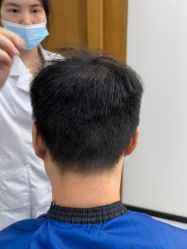 体验前-大麦微针植发全国连锁