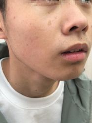 -痣斑堂·取大痣