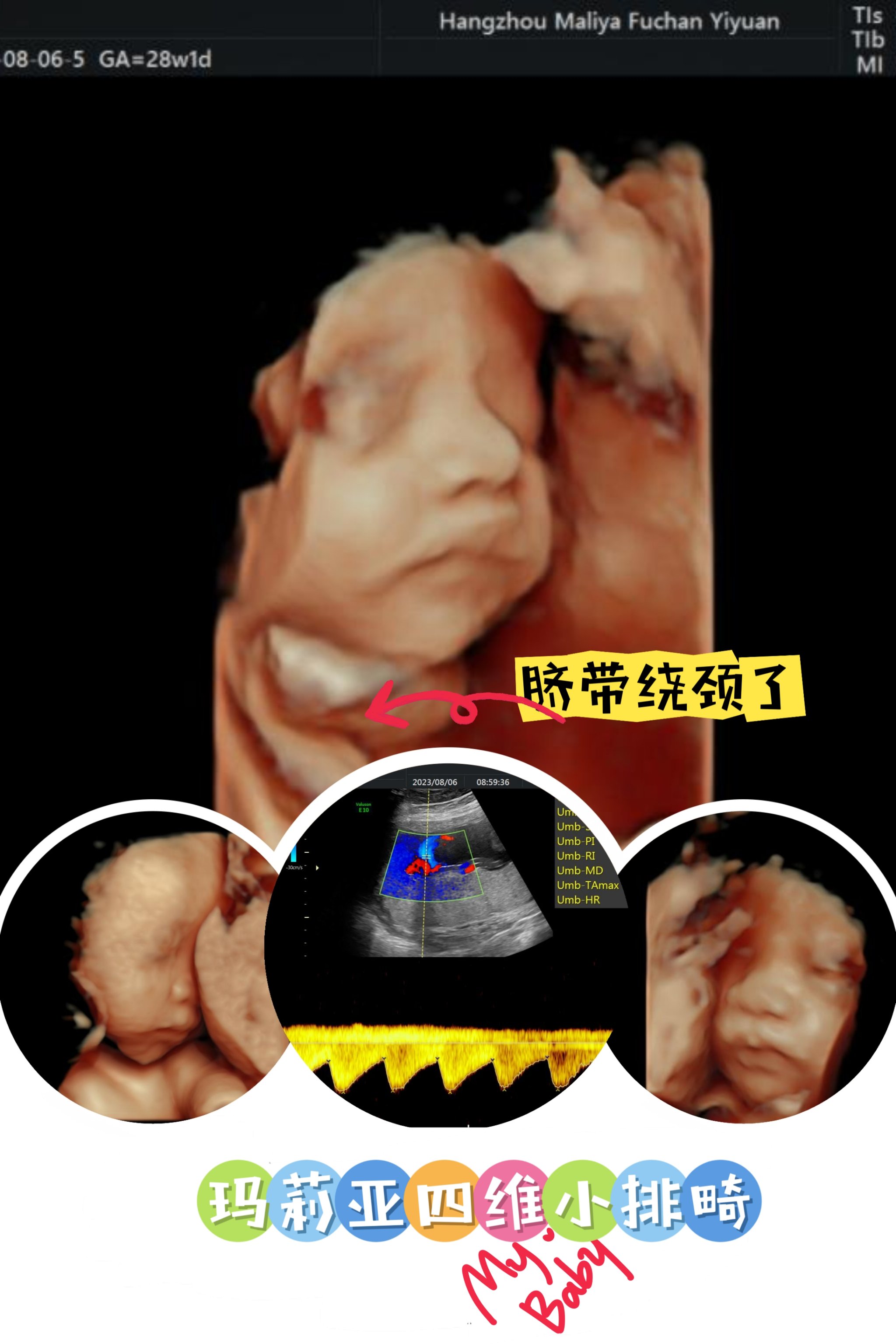 四维小排畸是指在怀孕28周左右进行的孕