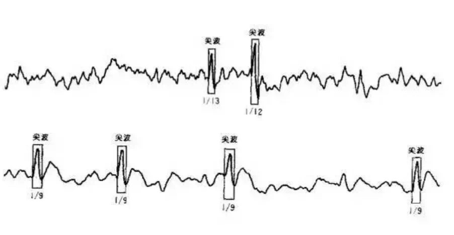 异常脑电图尖波尖慢波图片