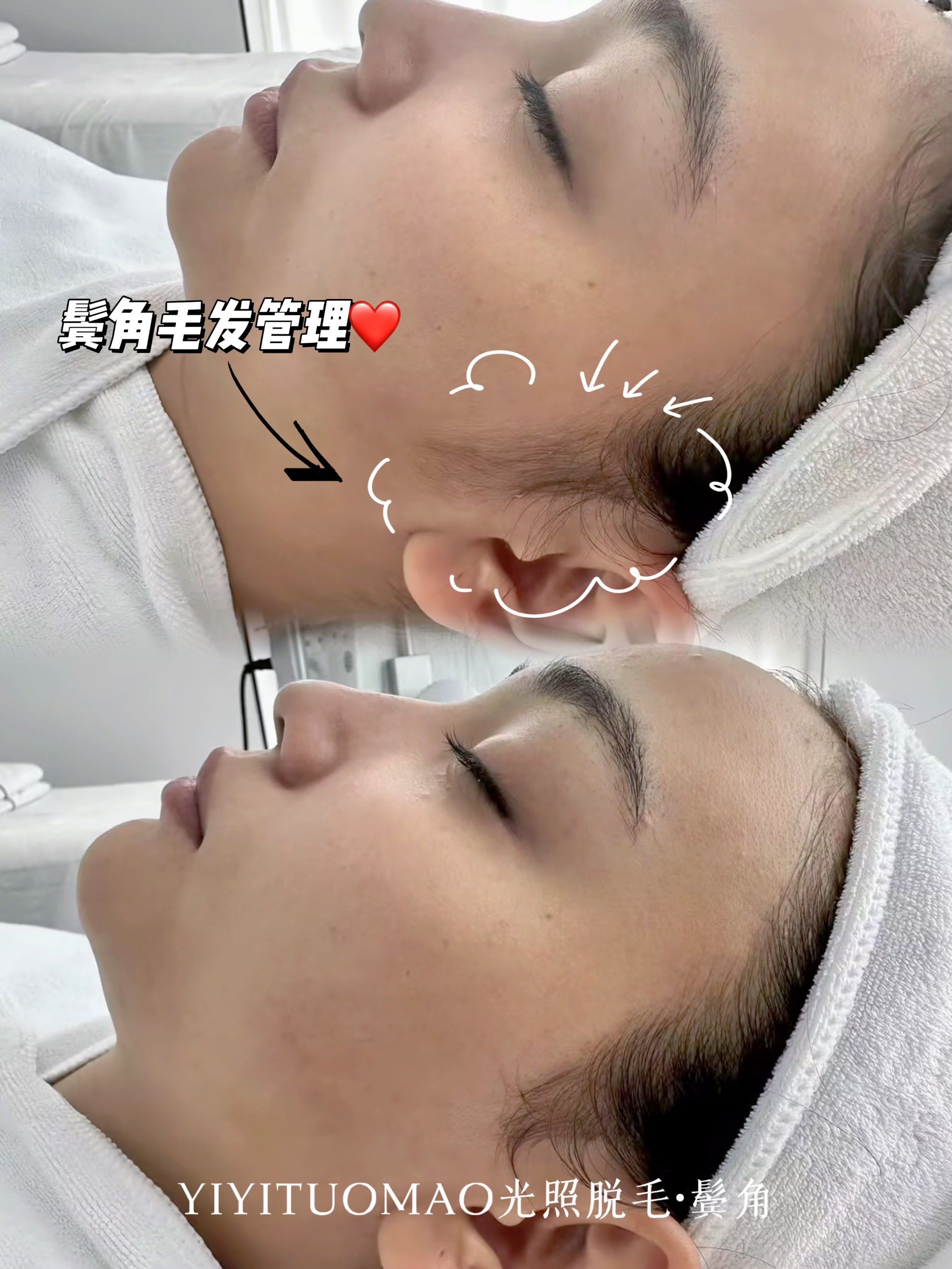 鬓角脱毛

去掉多余的毛发