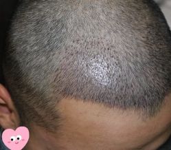 -大麦微针植发丨全国连锁