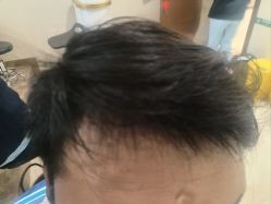 -碧莲盛·不剃发植发