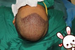 -大麦微针植发丨全国连锁