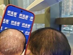 -碧莲盛·不剃发植发