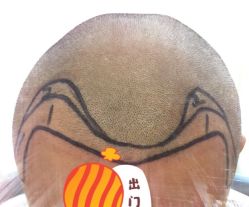 -大麦微针植发全国连锁