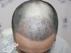 -大麦微针植发丨全国连锁