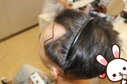 点击看大图 -大麦微针植发丨全国连锁