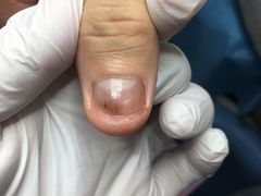 -Andrew指甲专科灰指甲·甲沟炎矫正·3D步态矫形鞋垫定制(上海法华镇路旗舰店)