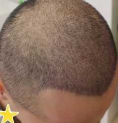 -大麦微针植发丨全国连锁