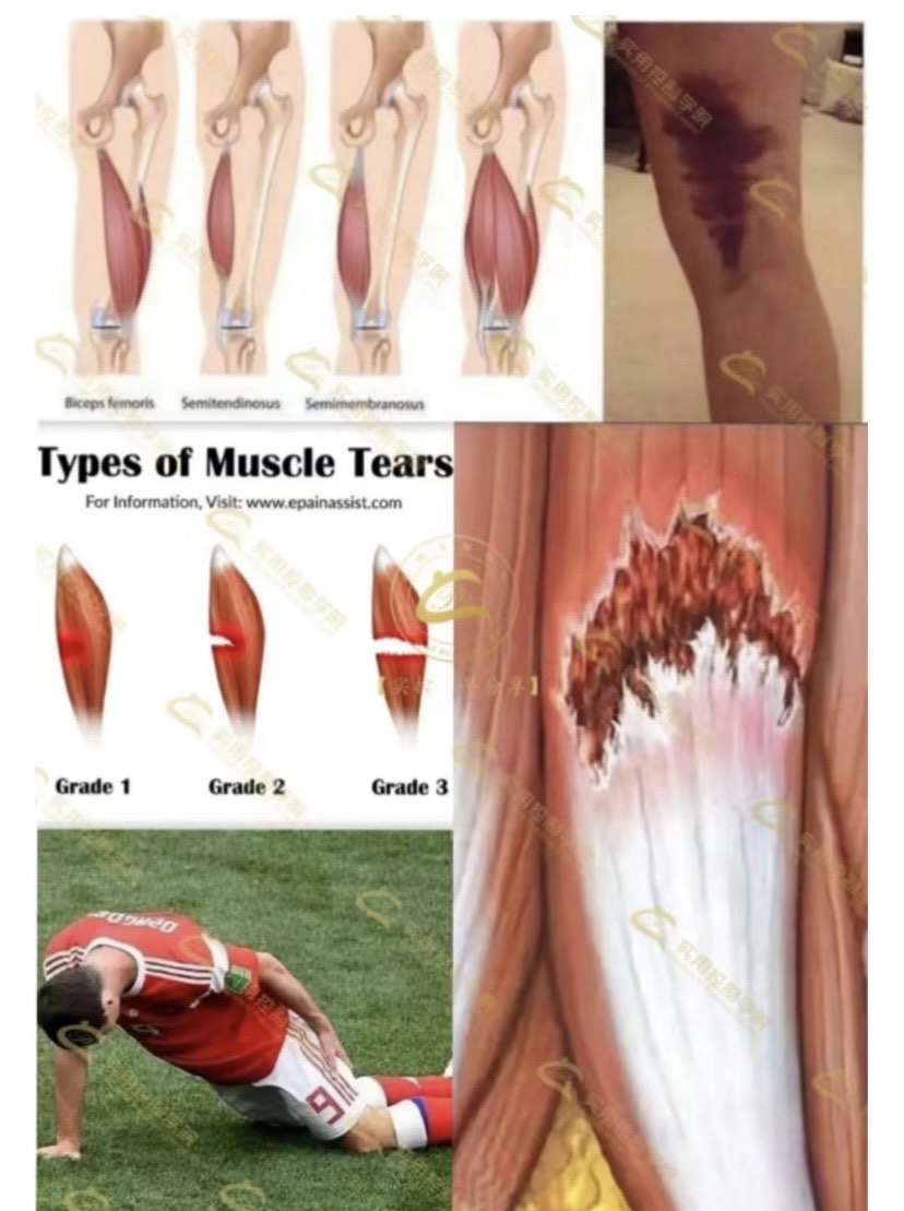 肌肉拉伤是肌肉在运动中急剧收缩或过度