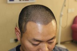 -大麦微针植发丨全国连锁