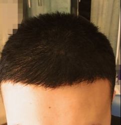 -大麦微针植发丨全国连锁