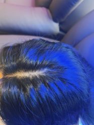 -碧莲盛·不剃发植发