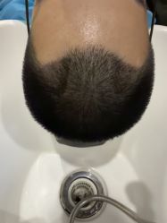 -大麦微针植发全国连锁
