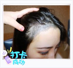 点击看大图 体验后-大麦微针植发全国连锁