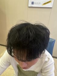 -大麦微针植发全国连锁