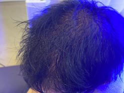 -碧莲盛·不剃发植发