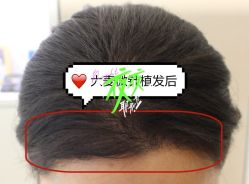 -大麦微针植发全国连锁