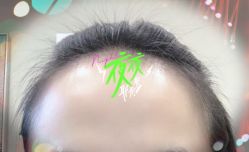 -大麦微针植发全国连锁