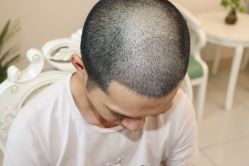 -大麦微针植发丨全国连锁