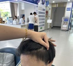 -大麦微针植发全国连锁