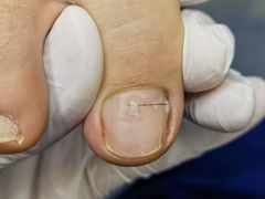 -Andrew指甲专科灰指甲·甲沟炎矫正·3D步态矫形鞋垫定制(上海法华镇路旗舰店)