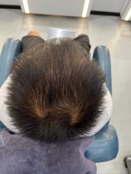 体验前-大麦微针植发全国连锁