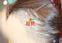 -大麦微针植发全国连锁