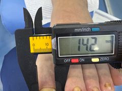 -Andrew指甲专科灰指甲·甲沟炎矫正·3D步态矫形鞋垫定制(浦三路店)