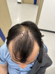 体验前-大麦微针植发全国连锁