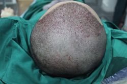 点击看大图 -大麦微针植发丨全国连锁