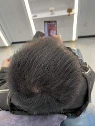 体验后-大麦微针植发全国连锁