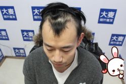 -大麦微针植发丨全国连锁