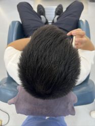 -大麦微针植发全国连锁