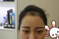 点击看大图 -大麦微针植发丨全国连锁