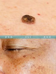 -清疣美疣·痣·斑净肤中心