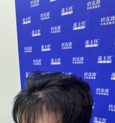 -碧莲盛·不剃发植发