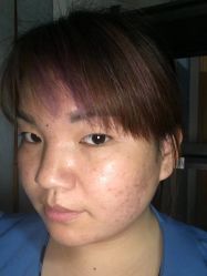 -荟草堂专业祛痘连锁机构