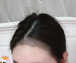 -大麦微针植发丨全国连锁