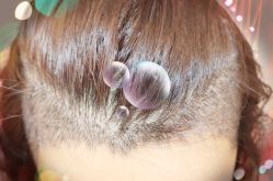 -大麦微针植发全国连锁