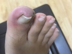 治疗前-Andrew指甲专科灰指甲·甲沟炎矫正·3D步态矫形鞋垫定制(上海法华镇路旗舰店)