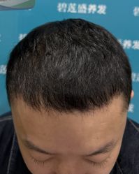 -碧莲盛·不剃发植发